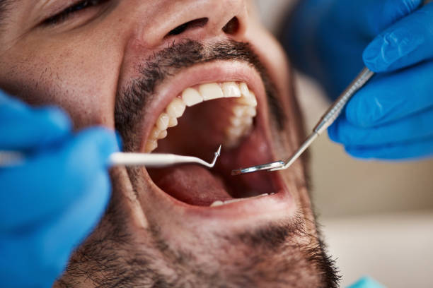 Best Emergency Dentist for Lost Fillings or Crowns in Midway, UT